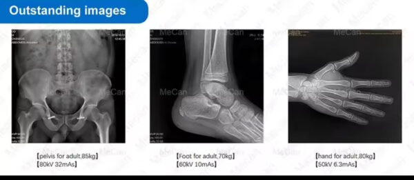 X-ray DR 5kw mobile  machine, medical portable digital  machine - Image 6